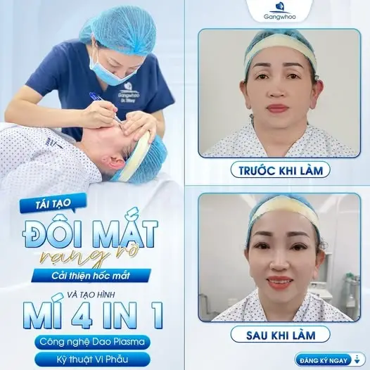 Tái tạo mỡ mắt không làm đứt gãy các mạch máu và giúp mô mỡ duy trì lâu dài hơn.