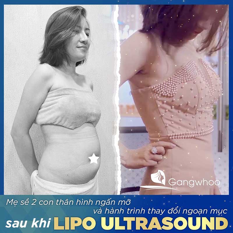 Khách hàng sử dụng lipo ultrasound