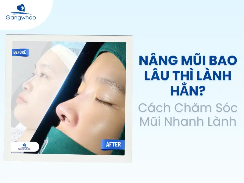 Nâng Mũi Bao Lâu Thì Lành Hẳn: 4 Yếu Tố Cần Lưu Ý