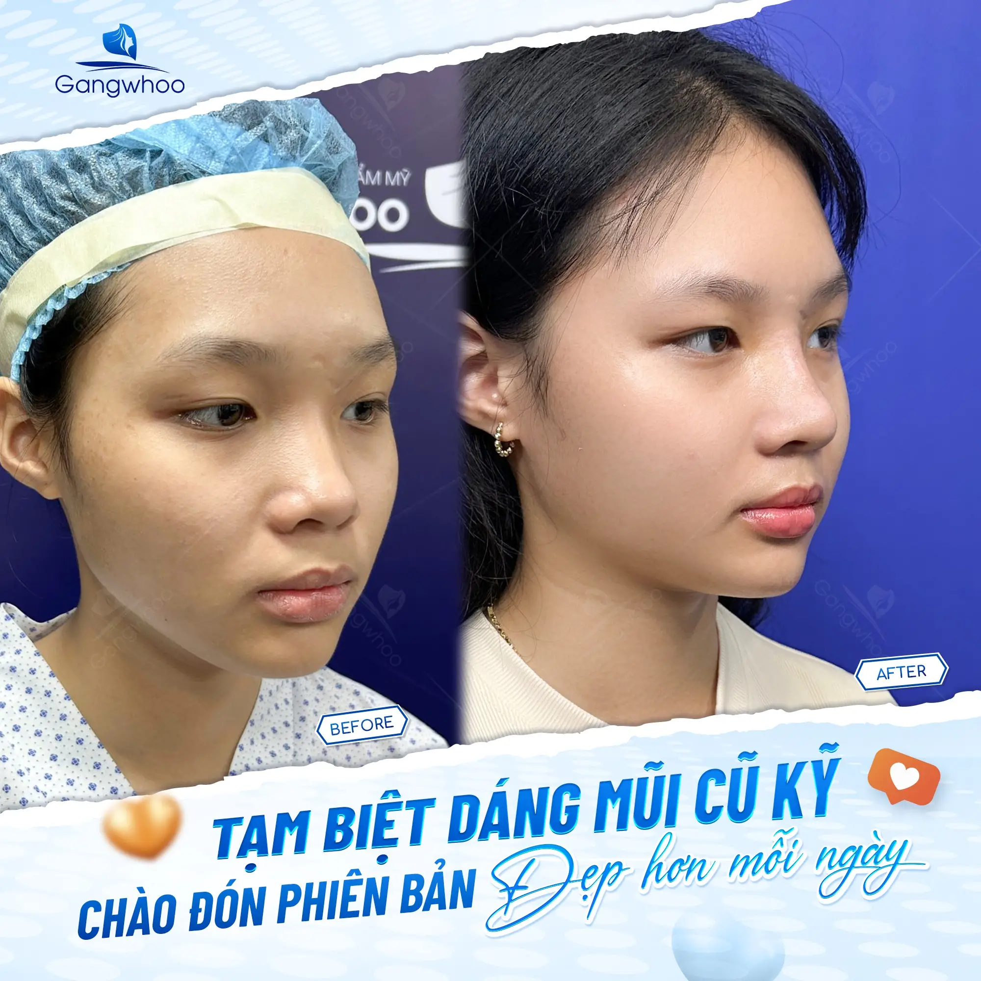 Nâng Mũi Sụn Sườn: Quy Trình – Ưu Điểm – Chi Phí