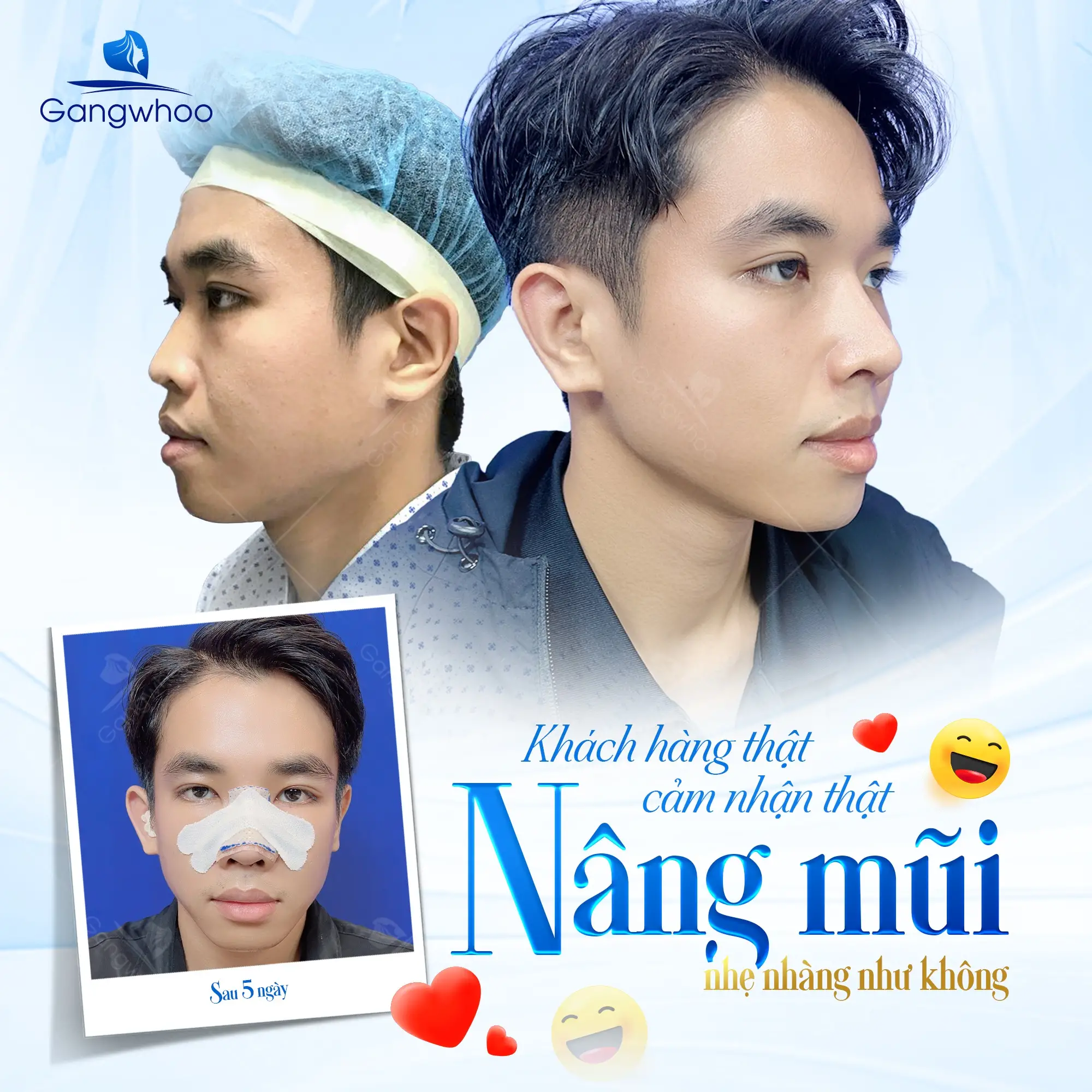 Nâng Mũi Sụn Sườn: Quy Trình – Ưu Điểm – Chi Phí