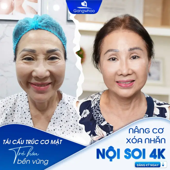 Top 3 Địa Chỉ Nâng Cơ Xóa Nhăn Hàng Đầu Ở TPHCM