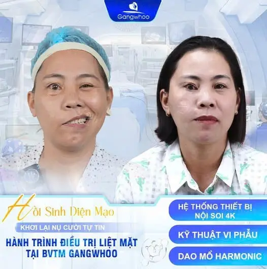 TMV Gangwhoo - Địa chỉ điều trị lệch mặt hàng đầu hiện nay