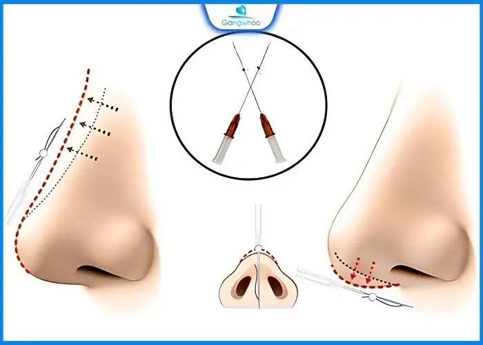 Nâng Mũi Bằng Chỉ Giải Pháp Cho Mũi Đẹp Không Phẫu Thuật