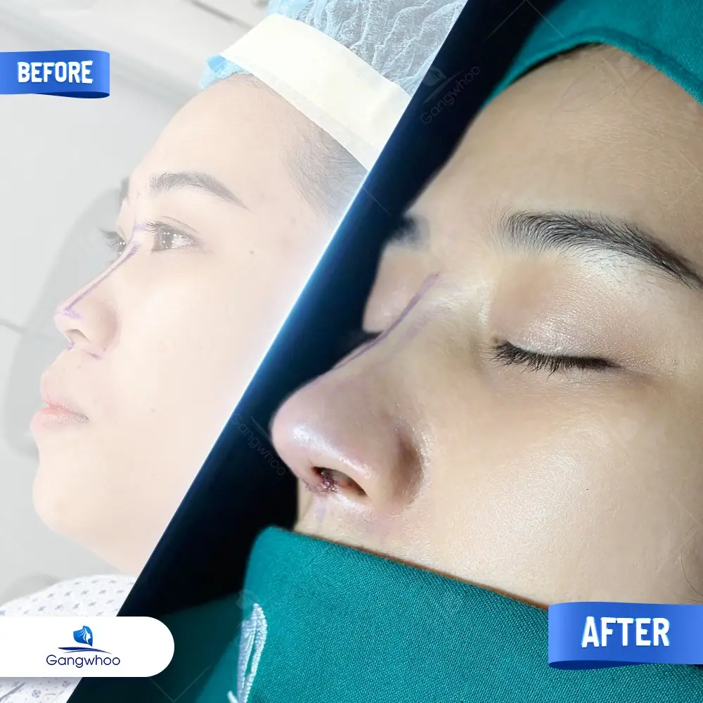 Nâng Mũi Bằng Chỉ Giải Pháp Cho Mũi Đẹp Không Phẫu Thuật