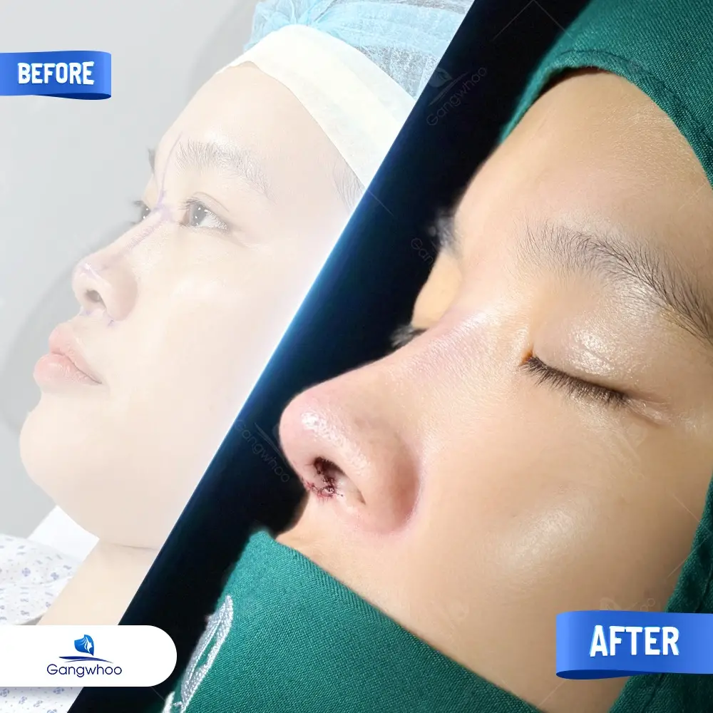 Nâng Mũi Bằng Chỉ Giải Pháp Cho Mũi Đẹp Không Phẫu Thuật