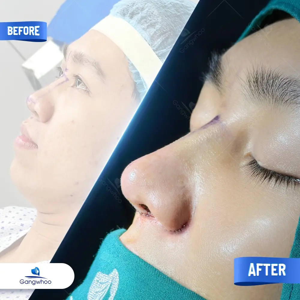 Nâng Mũi Bằng Chỉ Giải Pháp Cho Mũi Đẹp Không Phẫu Thuật