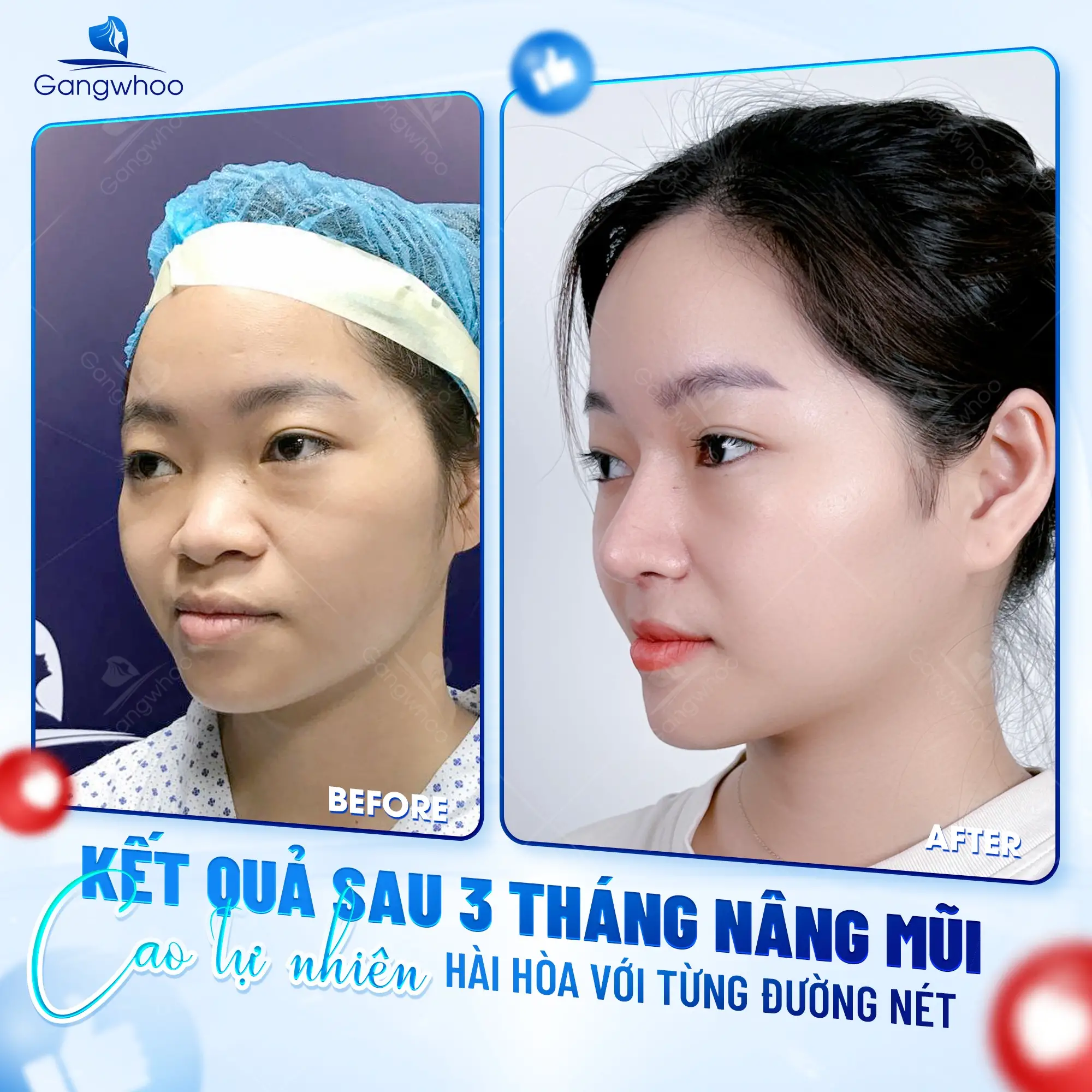 Nâng Mũi Bằng Chỉ Giải Pháp Cho Mũi Đẹp Không Phẫu Thuật