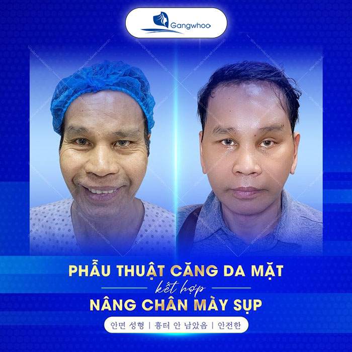 Treo chân mày nội soi khắc phục đáng kể tình trạng lão hóa