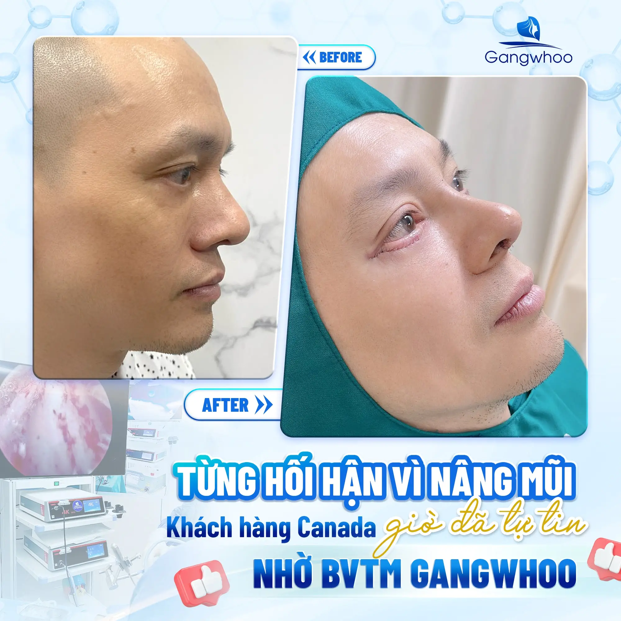 Nâng Mũi Bằng Chỉ Collagen Là Gì? Giá Bao Nhiêu? Có Tốt Không?