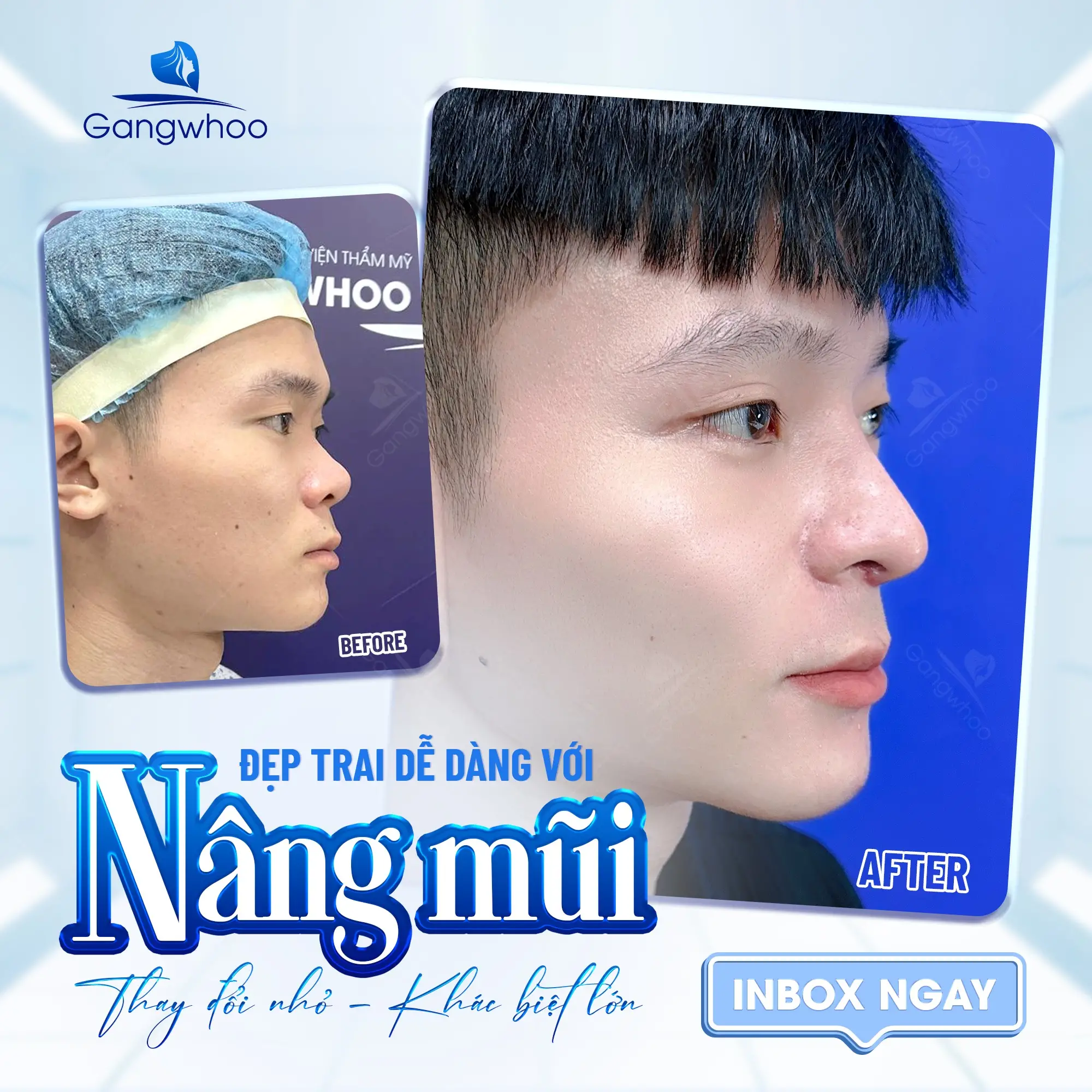 Nâng Mũi Bằng Chỉ Được Bao Lâu? Bác Sĩ Gangwhoo Giải Đáp