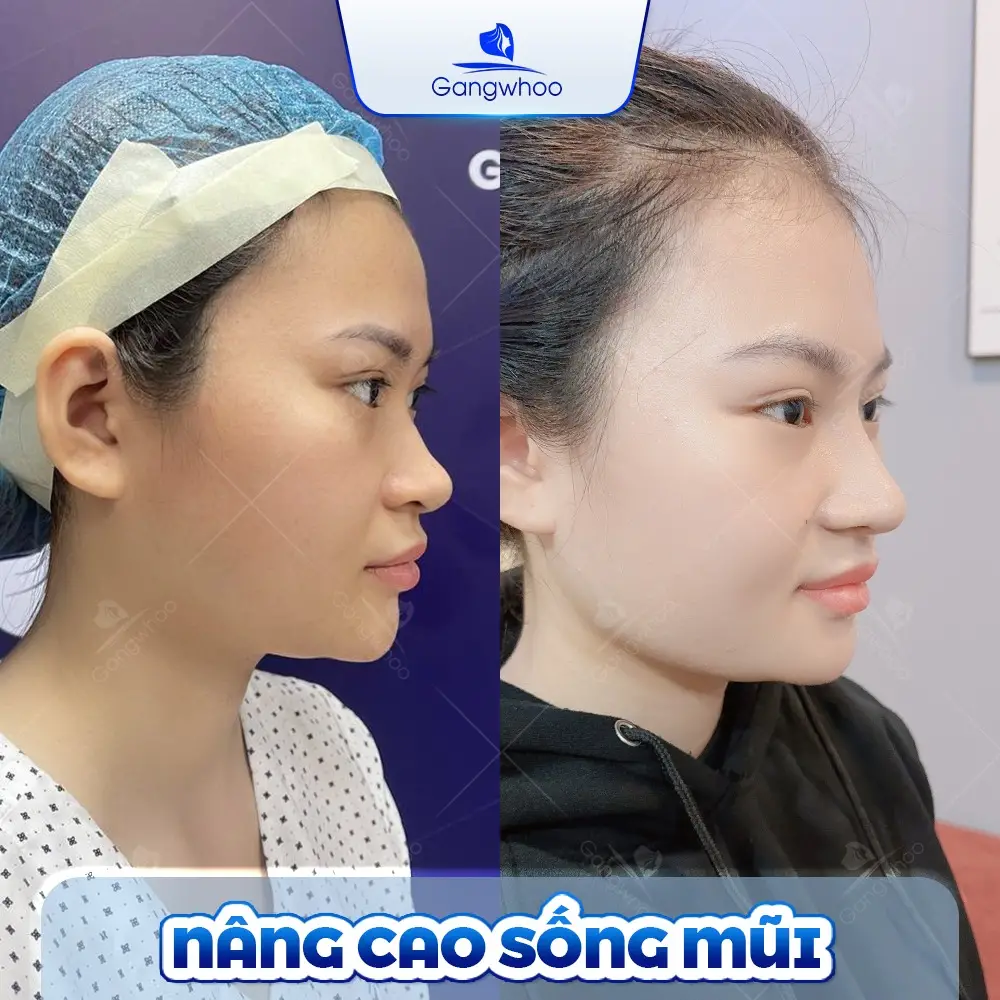 Nâng Mũi Bằng Chỉ Được Bao Lâu? Bác Sĩ Gangwhoo Giải Đáp