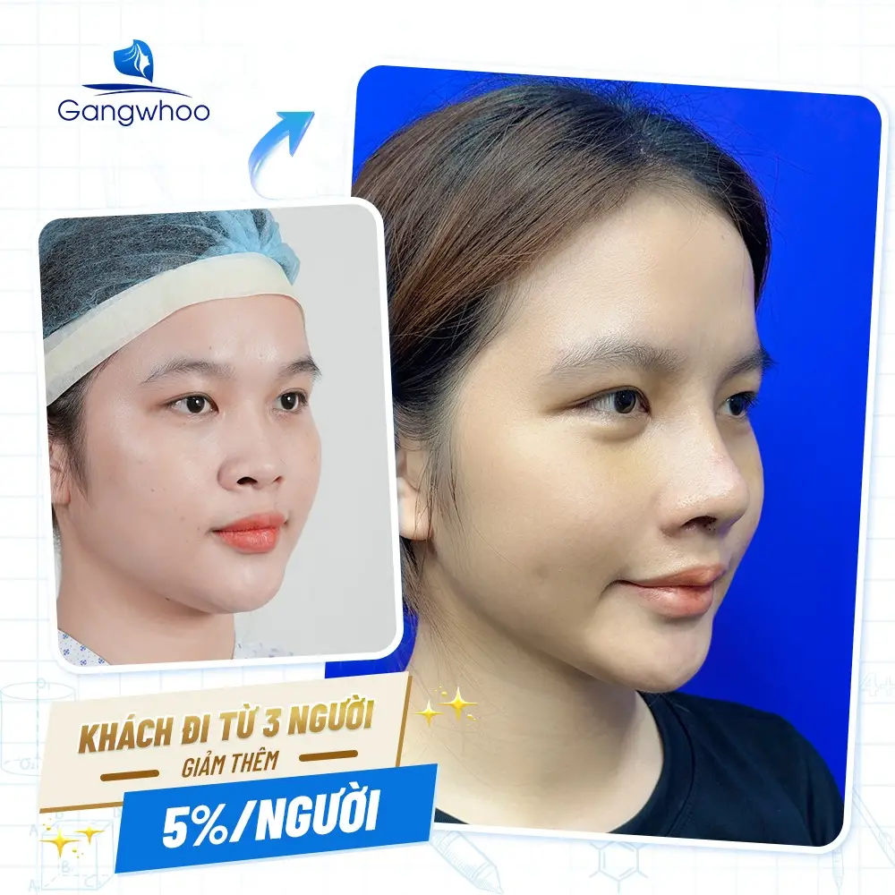 Top 9+ Cách Làm Mũi Cao Lên Tự Nhiên Ngay Tại Nhà Hiệu Quả