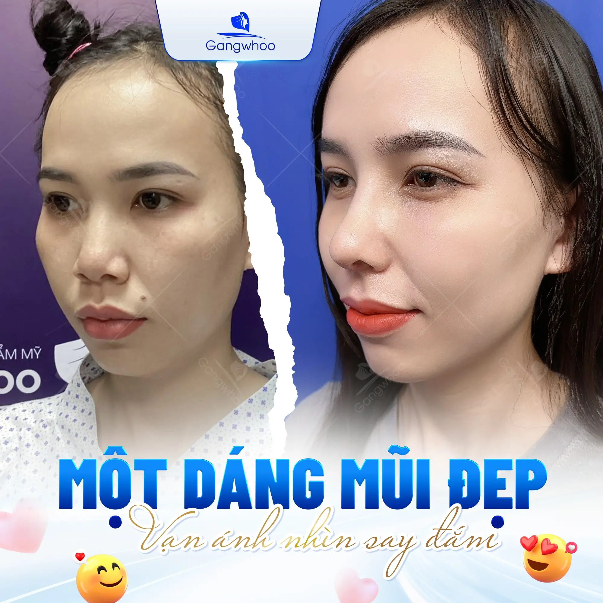 Top 9+ Cách Làm Mũi Cao Lên Tự Nhiên Ngay Tại Nhà Hiệu Quả