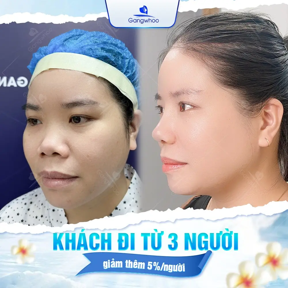 Top 9+ Cách Làm Mũi Cao Lên Tự Nhiên Ngay Tại Nhà Hiệu Quả