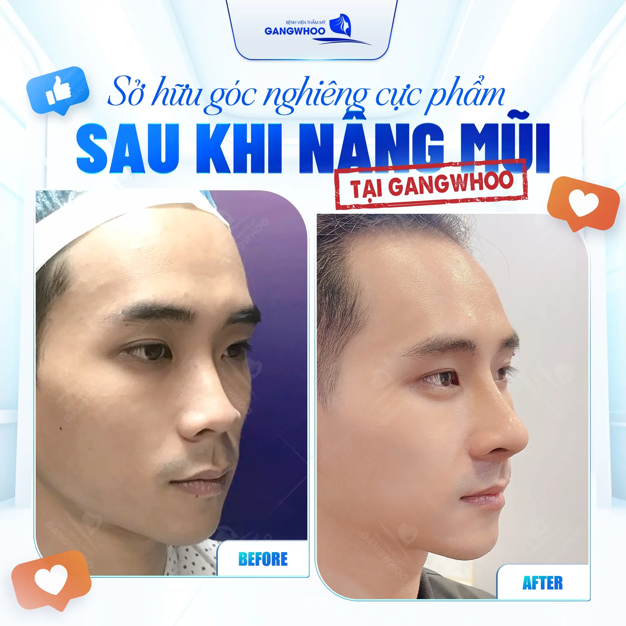 Top 9+ Cách Làm Mũi Cao Lên Tự Nhiên Ngay Tại Nhà Hiệu Quả