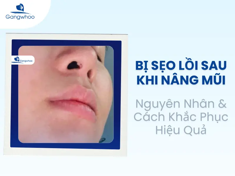 Bị Sẹo Lồi Sau Khi Nâng Mũi: Nguyên Nhân & Cách Khắc Phục Hiệu Quả
