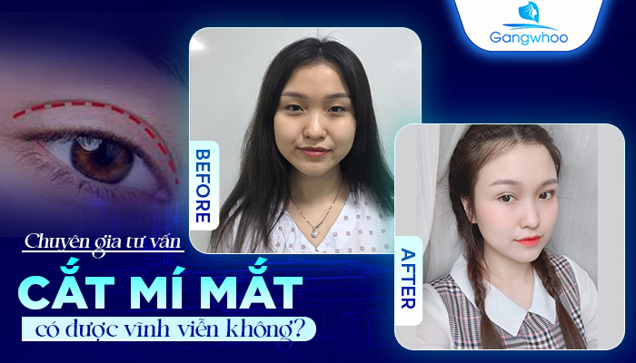 Cắt Mí Mắt Có Được Vĩnh Viễn Không? Chuyên Gia Tư Vấn