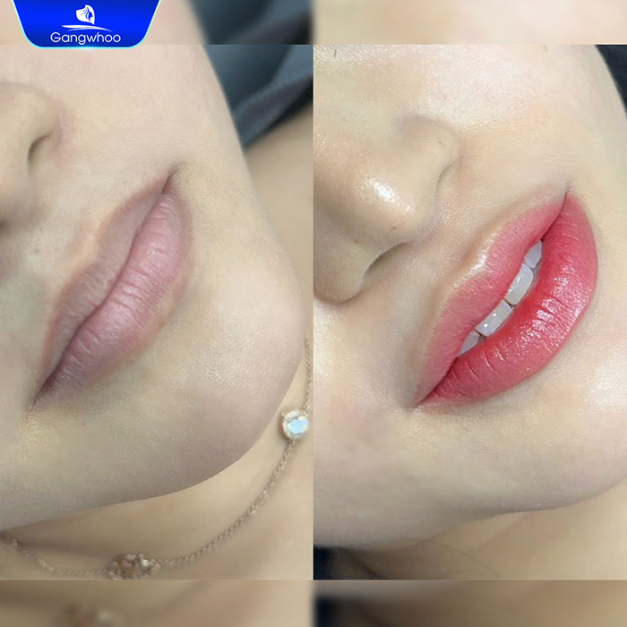 Giải quyết tình trạng môi thâm chỉ sau duy nhất 1 liệu trình khử thâm môi