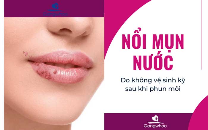 Phun môi bị tụ máu bầm có nguy hiểm không và cách điều trị