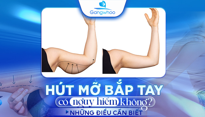 Hút Mỡ Bắp Tay Có Nguy Hiểm Không? Những Điều Cần Biết