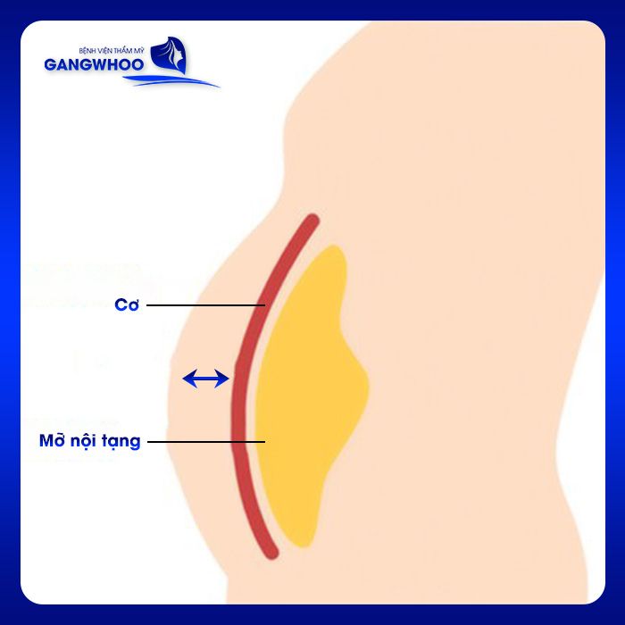 Nịt bụng sau khi hút mỡ hạn chế tối đa tình trạng co dãn cơ vùng ngăn ngừa việc tụ mỡ thừa trở lại