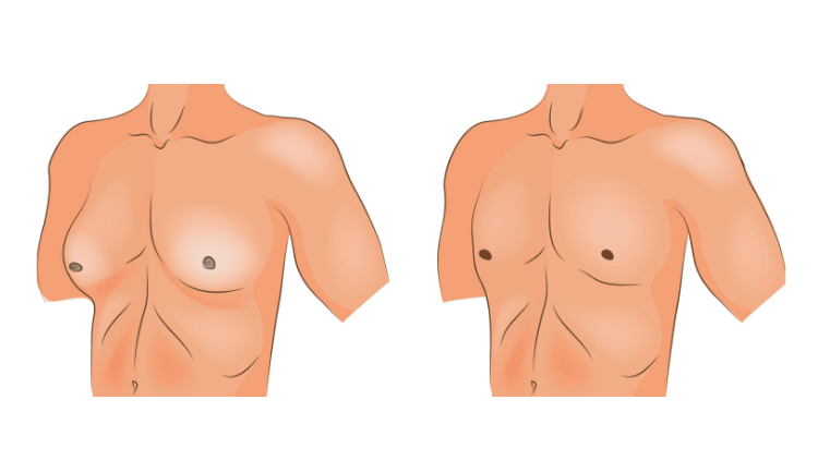 Triệu chứng đầu tiên của nữ hóa tuyến vú ở nam giới là ngực to hơn so với mức bình thường 