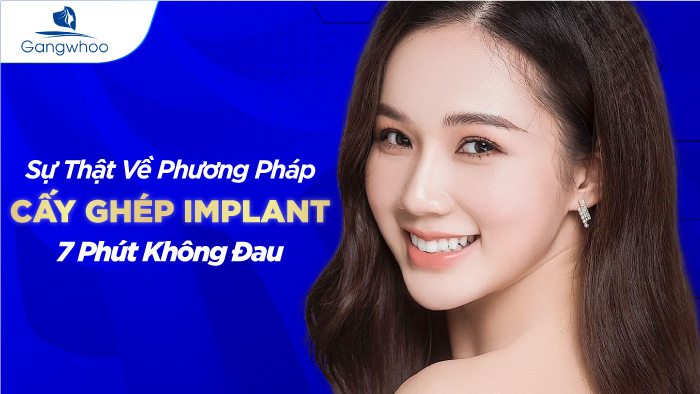 Cấy Ghép Implant 7 Phút Không Đau