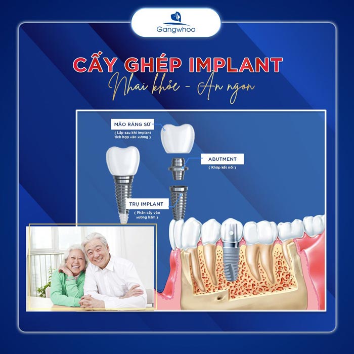 Cấy Ghép Implant All On 6 – Giải Pháp Cho Nụ Cười Tự Tin 3