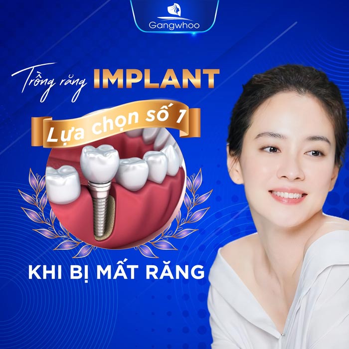 Ghép Xương Cấy Implant Được Thực Hiện Như Thế Nào? 3