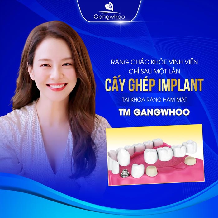 TOP 6+ Trung Tâm Cấy Ghép Implant Sài Gòn Uy Tín Hiện Nay 4
