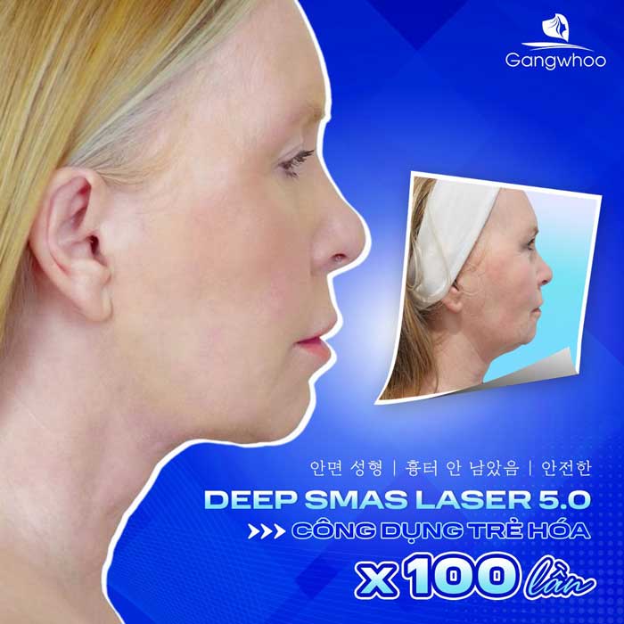 Căng Da Mặt Deep Smas Laser 5.0 – Đỉnh Cao Công Nghệ Trẻ Hoá Không Phẫu Thuật 2