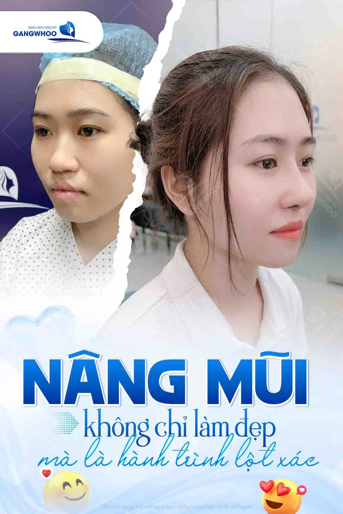 Nâng mũi Zose - Line là công nghệ nâng mũi hiện đại có nguồn gốc từ xứ sở Kim Chi