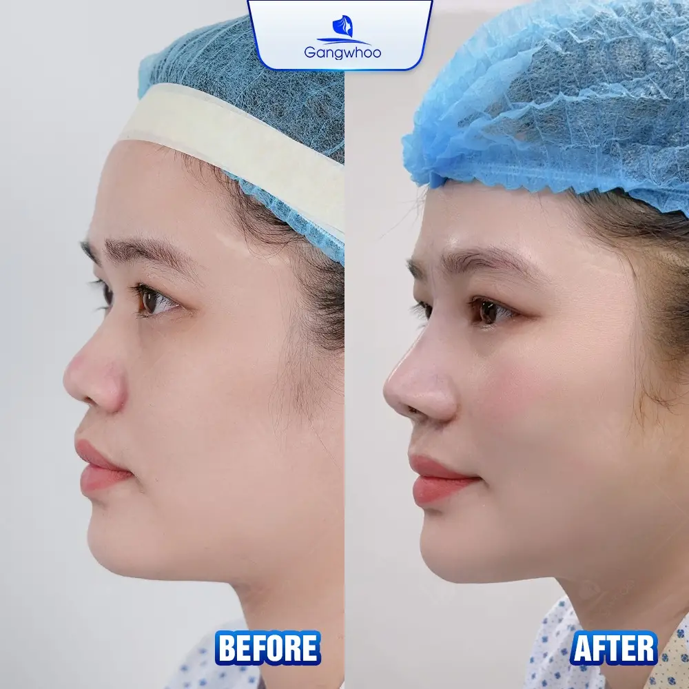 Nâng Mũi Zose – Line: Cá Nhân Hóa Dáng Mũi – Khơi Dậy Cá Tính Riêng