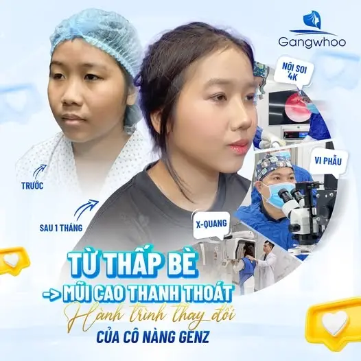 Mũi đẹp độc bản với phương pháp nâng mũi Zose - Line