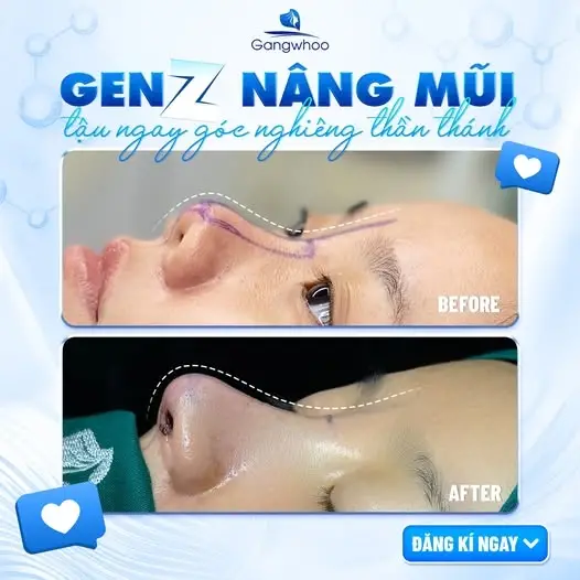 Nâng mũi Zose - Line, phương pháp nâng mũi dành riêng cho Gen Z