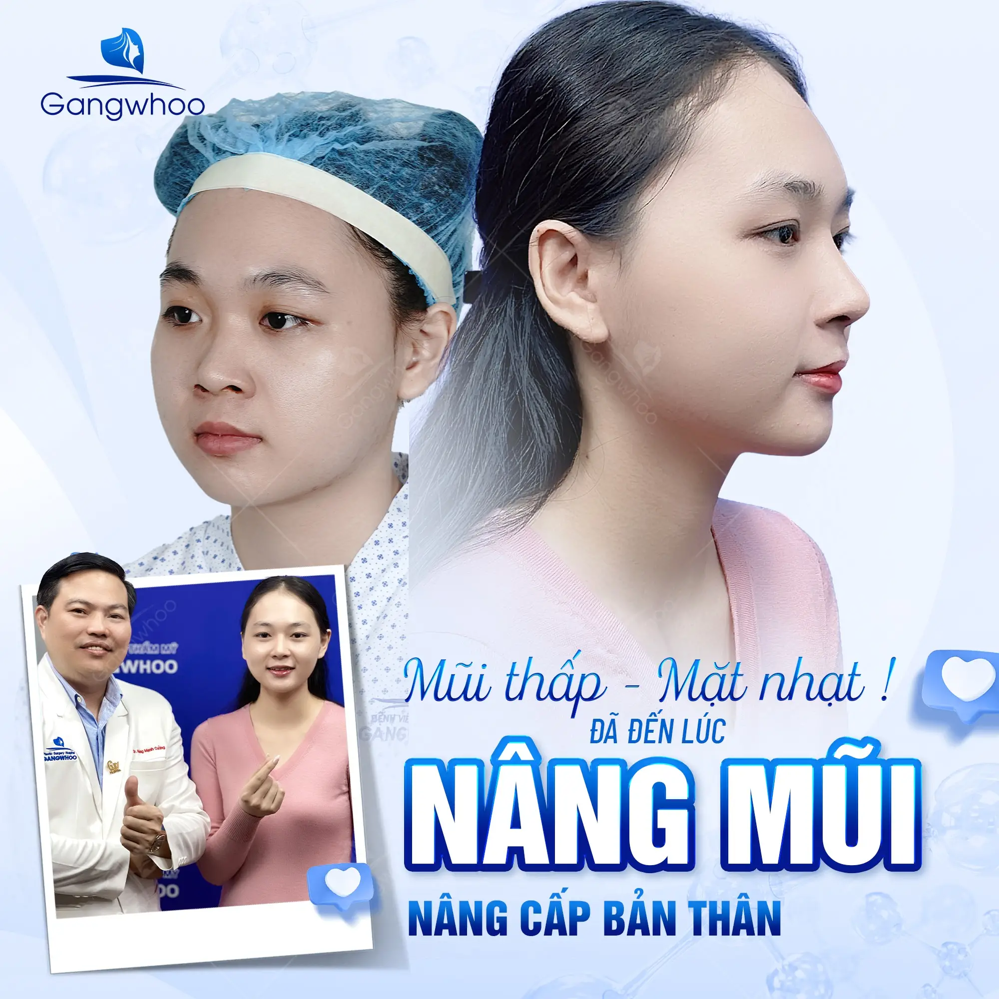 Nâng Mũi Zose – Line: Cá Nhân Hóa Dáng Mũi – Khơi Dậy Cá Tính Riêng