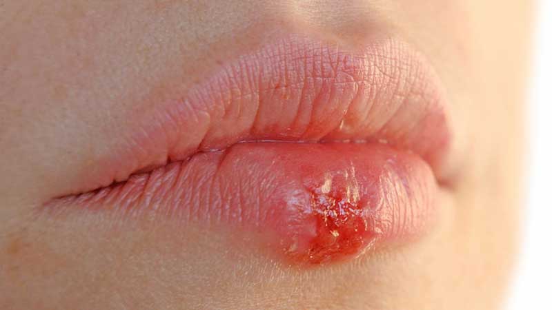 Sưng môi đi kèm với dấu hiệu lở loét bạn nên đến ngay bác sĩ để được thăm khám và điều trị kịp thời
