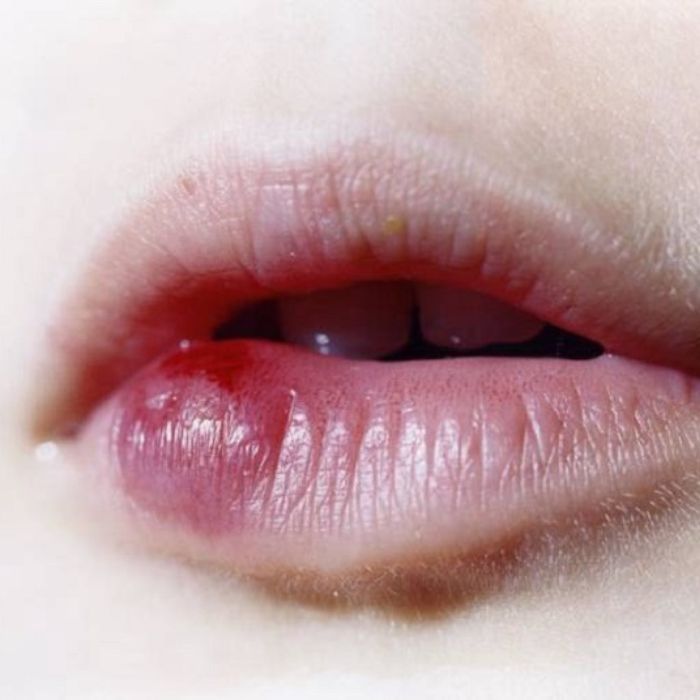 Nhiễm trùng không chỉ ảnh hưởng đến kết quả phun môi, mà còn gây nguy hiểm cho sức khỏe của bạn. 