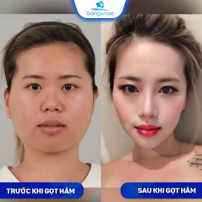 Gọt hàm bao lâu thì hết sưng? 3 tip giảm sưng dành cho bạn