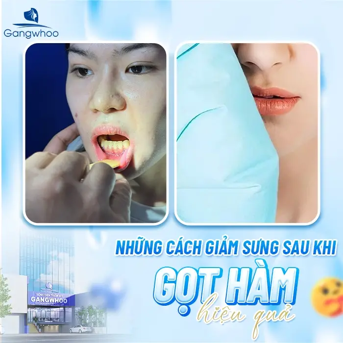 Những cách giảm sưng sau khi gọt hàm hiệu quả