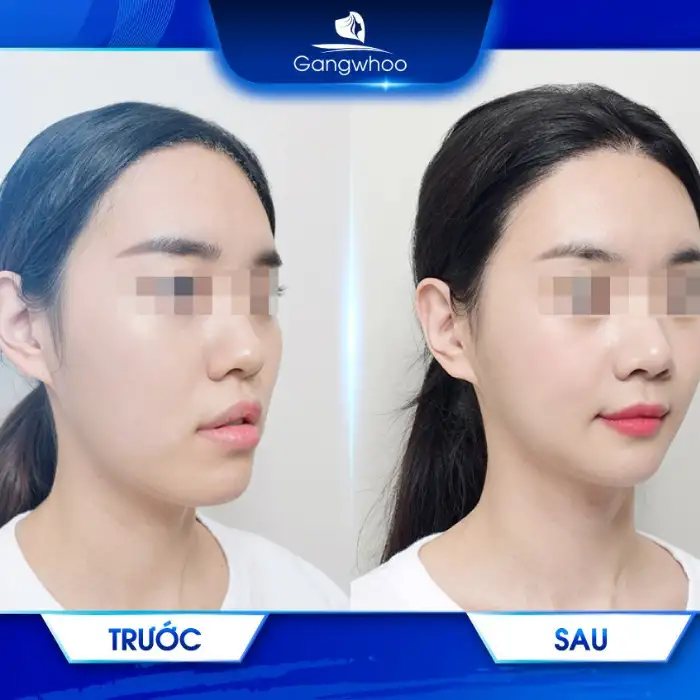 Gọt hàm bao lâu thì hết sưng? 3 tip giảm sưng dành cho bạn