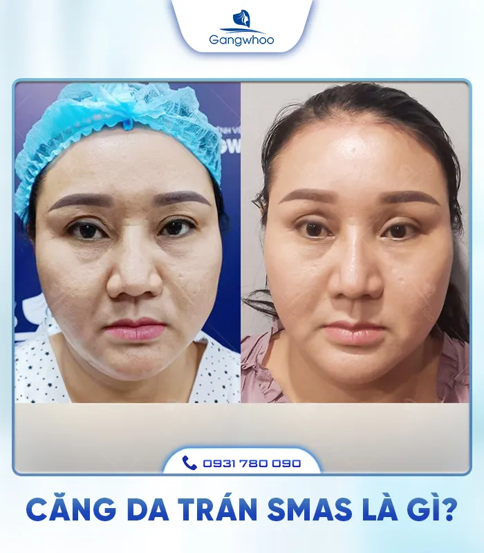 Căng Da Trán SMAS – Trẻ Hóa Làn Da Lấy Lại Thanh Xuân