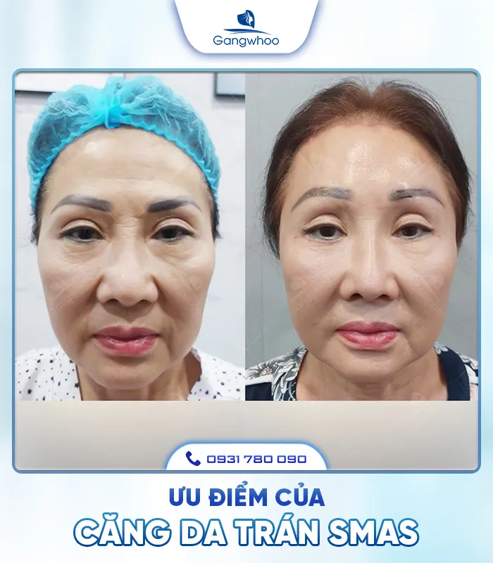 Căng Da Trán SMAS – Trẻ Hóa Làn Da Lấy Lại Thanh Xuân
