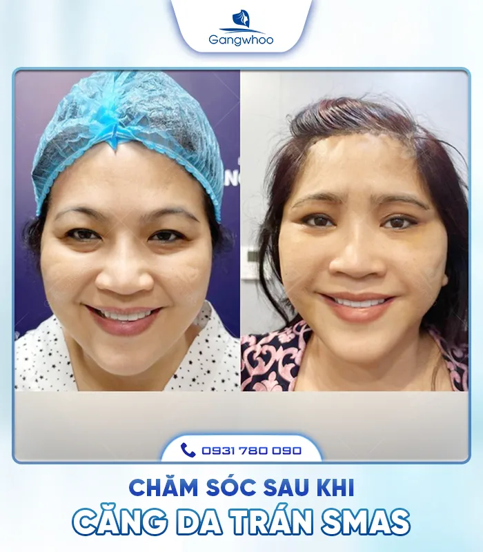 Căng Da Trán SMAS – Trẻ Hóa Làn Da Lấy Lại Thanh Xuân
