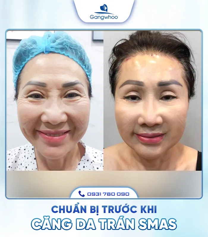 Căng Da Trán SMAS – Trẻ Hóa Làn Da Lấy Lại Thanh Xuân