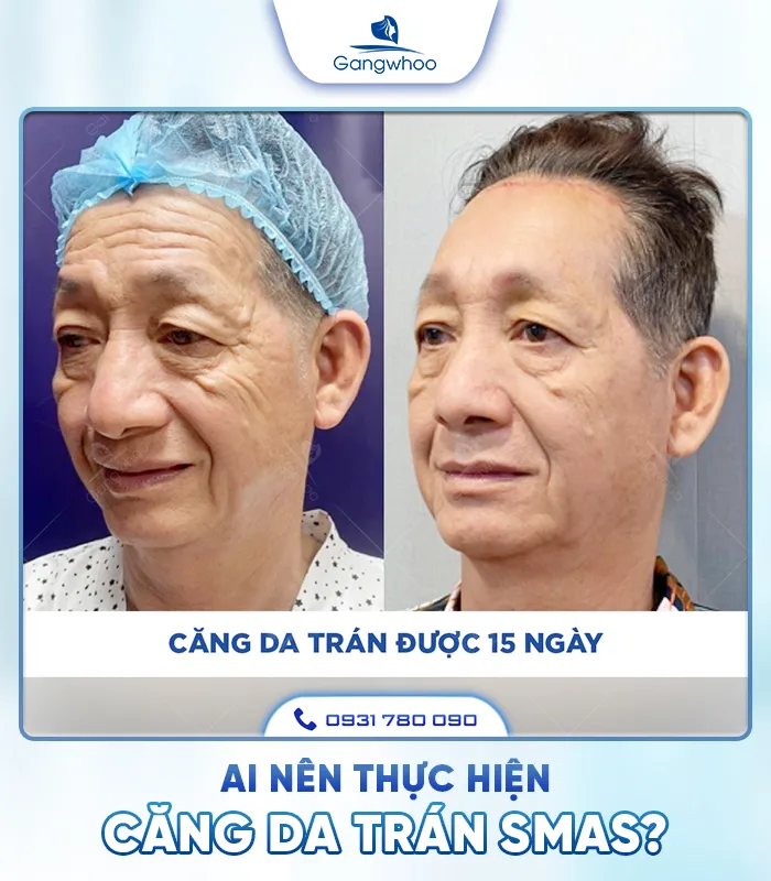 Căng Da Trán SMAS – Trẻ Hóa Làn Da Lấy Lại Thanh Xuân