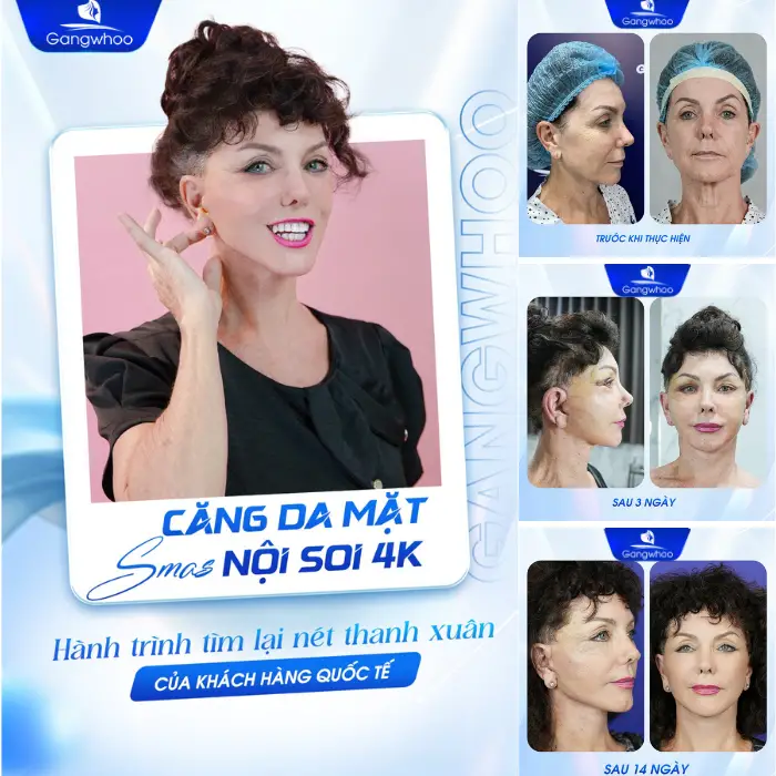 Căng da mặt nội soi là như thế nào? Phù hợp cho ai?   