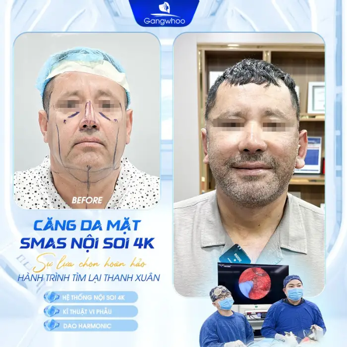 Căng da mặt nội soi là như thế nào? Phù hợp cho ai?   