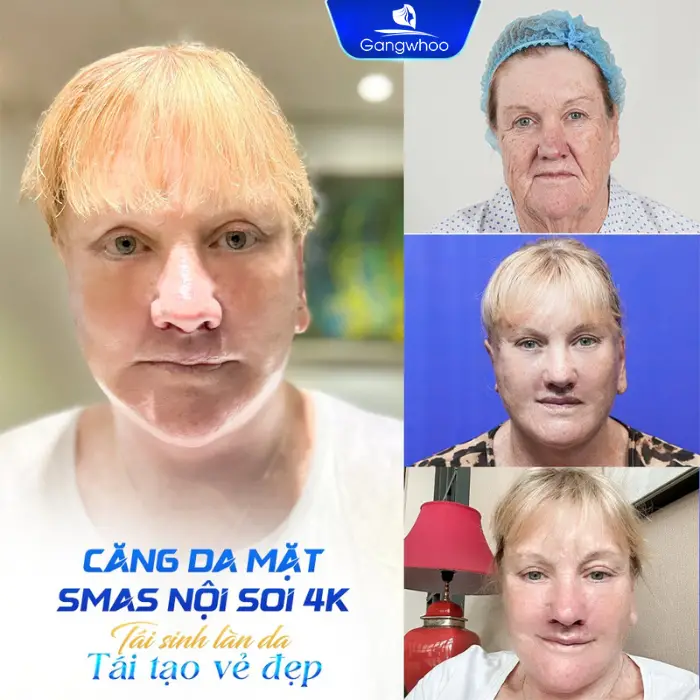 Căng da mặt nội soi ở đâu tốt? Gợi ý 5 địa chỉ uy tín